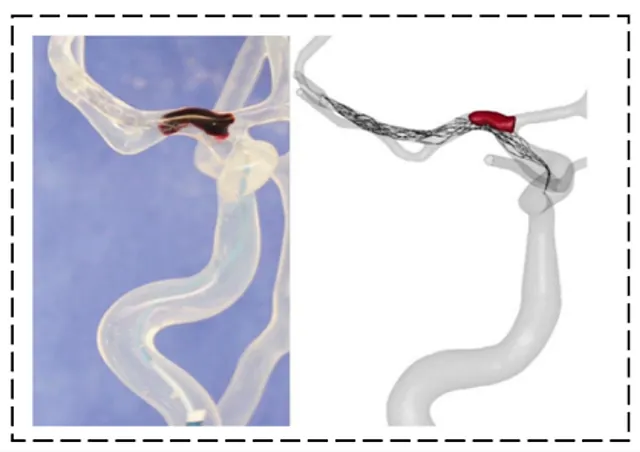 InSteps: Optimize Stroke Device Design, Clinical Trials & Regulatory ...